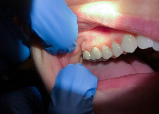 Best Emergency Tooth Extraction in Moraga, CA