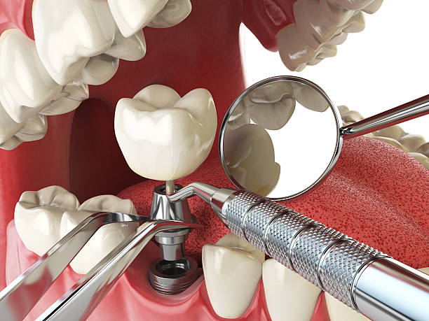 Best Emergency Wisdom Teeth Removal in Moraga, CA